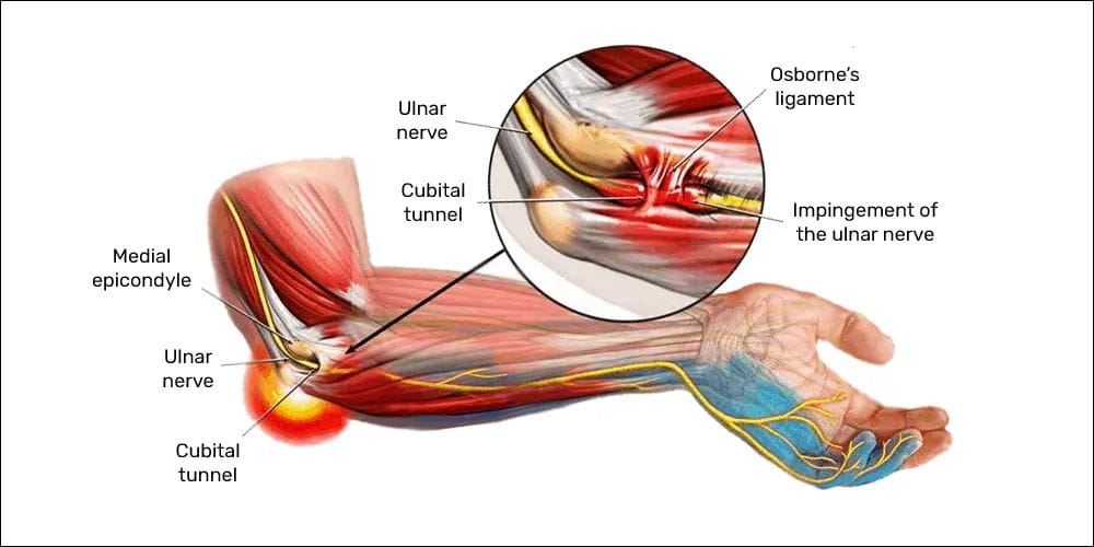 Cubital Tunnel Syndrome - Tran Plastic Surgery