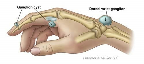 Ganglion Cyst of the Wrist and Hand