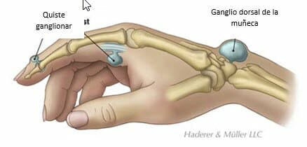 Quiste ganglionar de la muñeca y mano