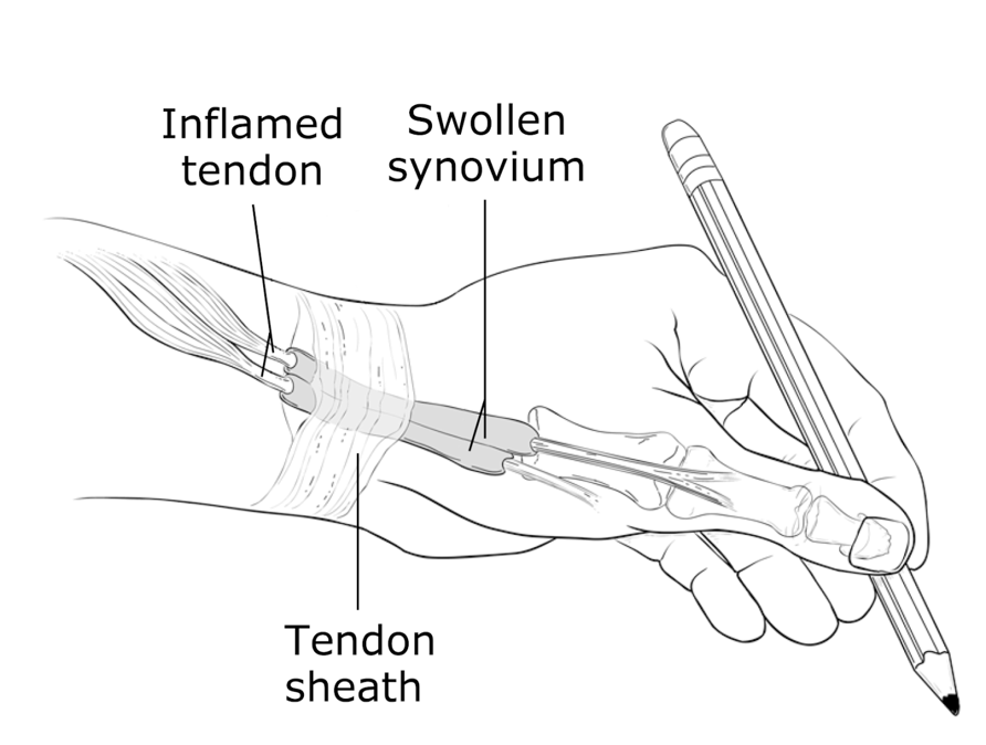 Radial Styloid Tenosynovitis