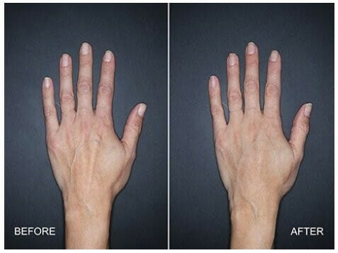 Hand Rejuvenation  with Fat Grafting vs Fillers