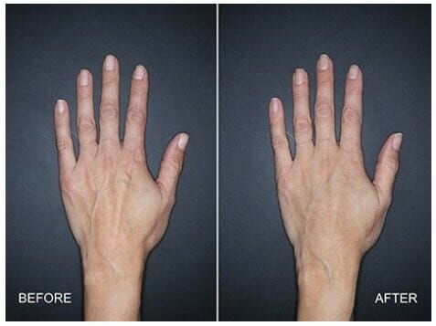 Cấy Ghép Mỡ Trẻ Hóa Bàn Tay vs. Tiêm Fillers