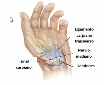 Síndrome del túnel carpiano