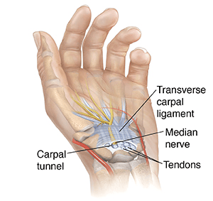 Carpal Tunnel Syndrome