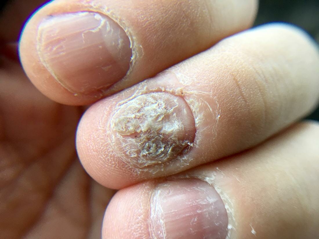Onicomicosis (hongos en las uñas)