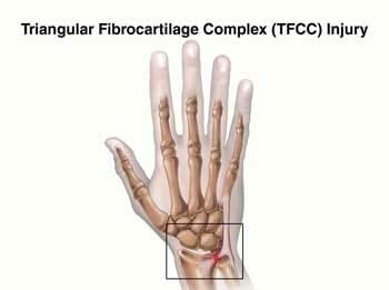 Triangular Fibrocartilage Complex Injury