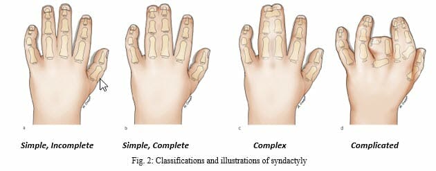 Medical illustration showing classifications of syndactyly in the hand