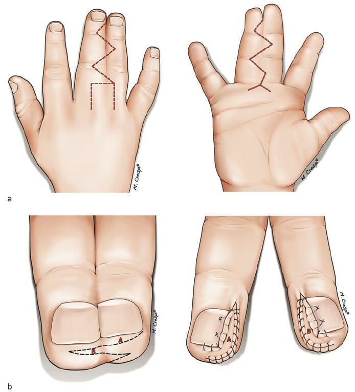 Syndactyly release surgery with z-plasty technique.