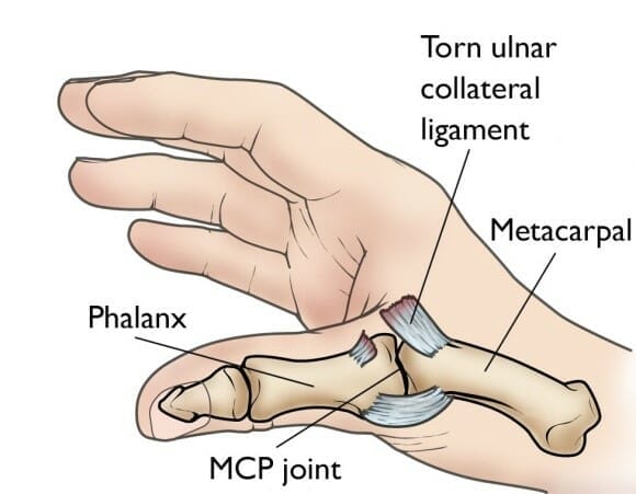 Thumb Ulnar Collateral Ligament Tear