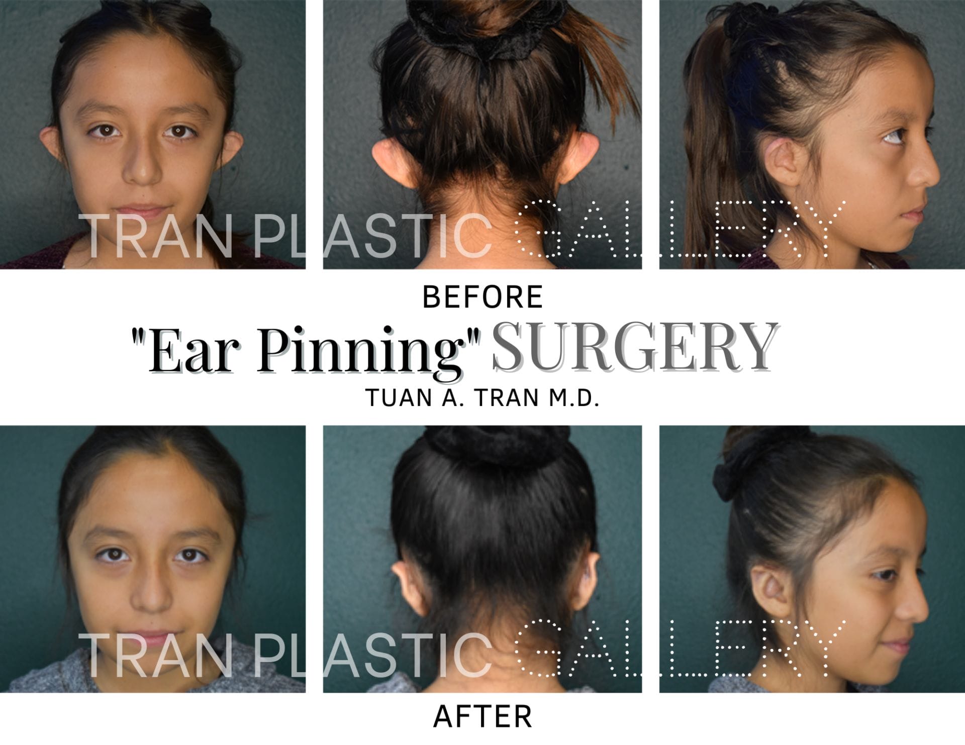 Tran Plastic Surgery - Ear Pinning