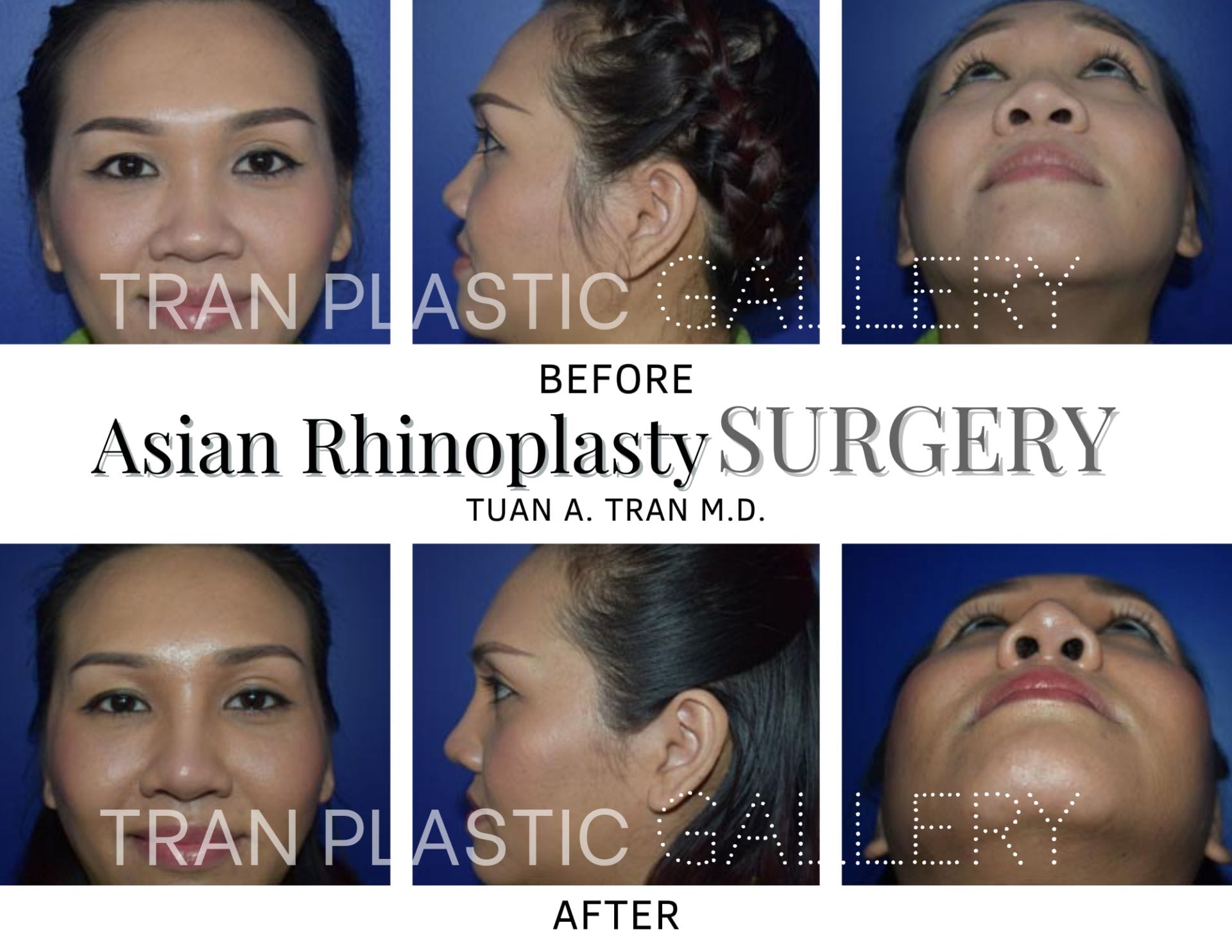 Tran Plastic Surgery - Asian Rhinoplasty