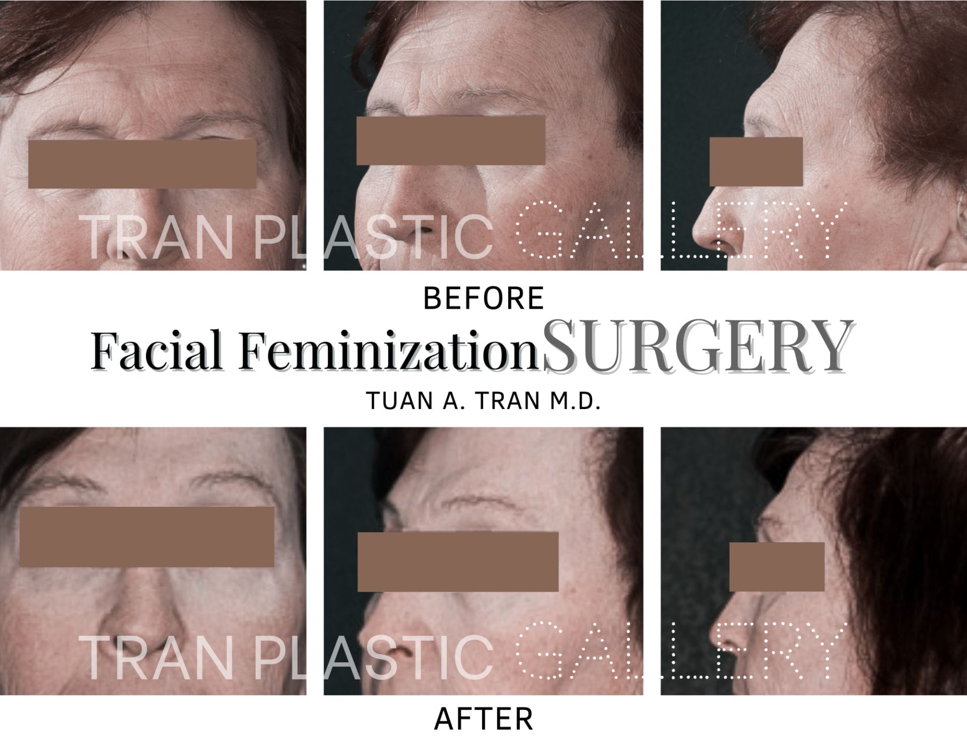Tran Plastic Surgery - Facial Feminization