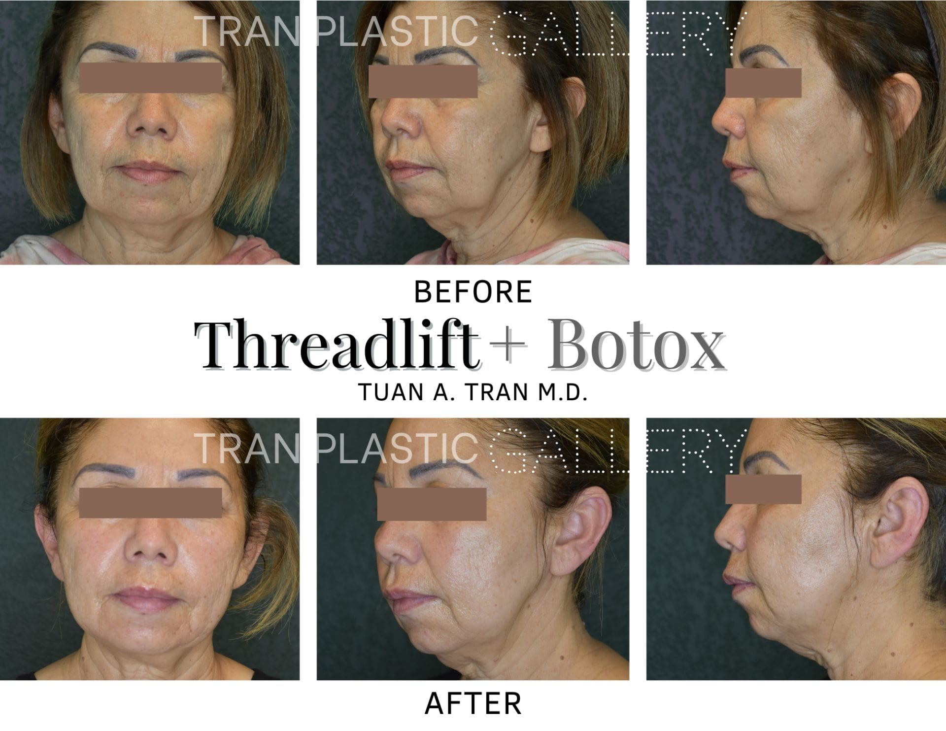 Tran Plastic Surgery - Threadlift Botox