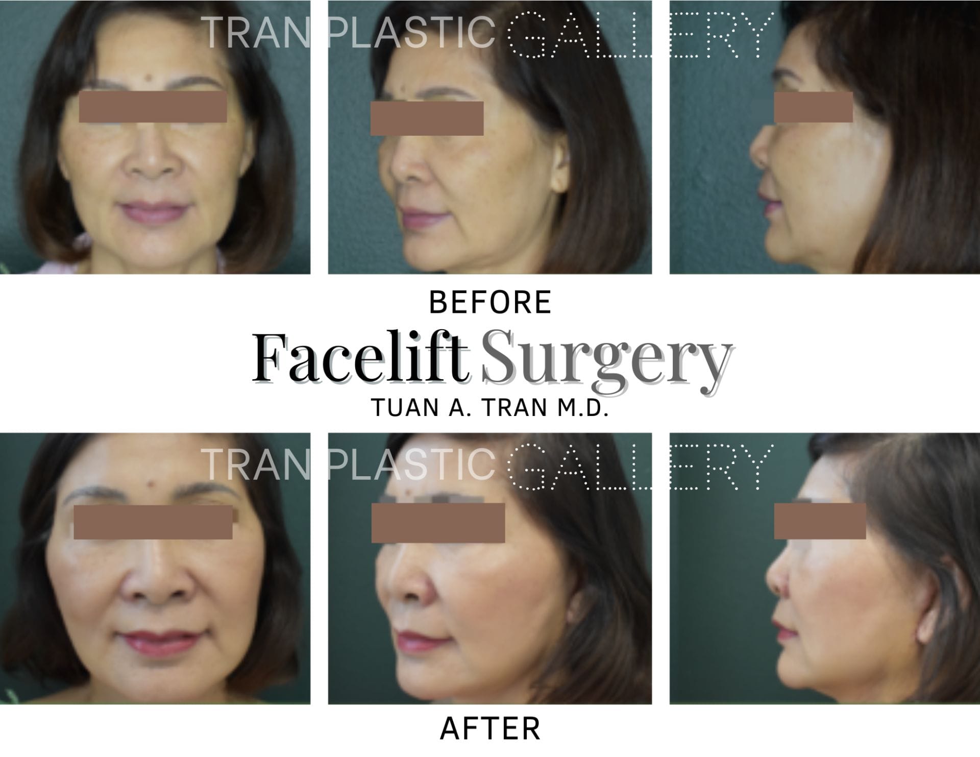 Tran Plastic Surgery - Facelift