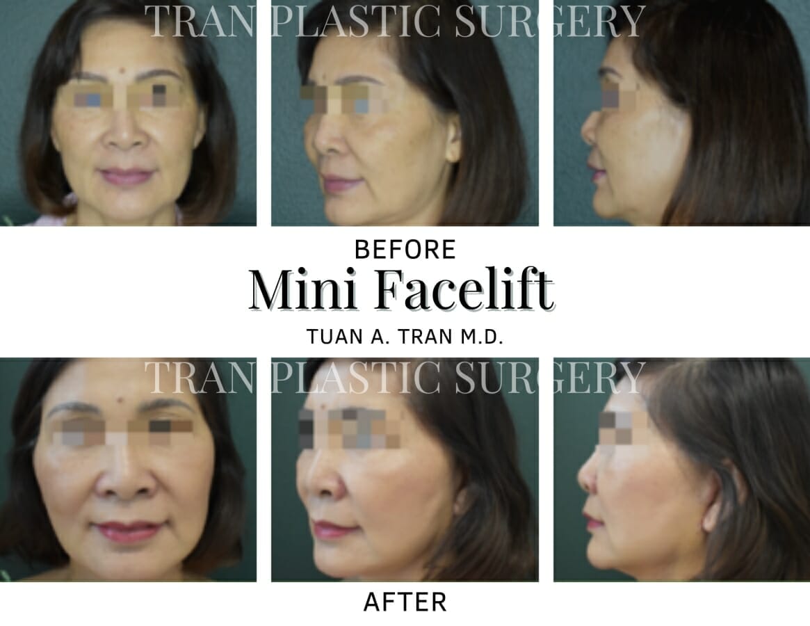 Facelift surgery at Tran Plastic Surgery