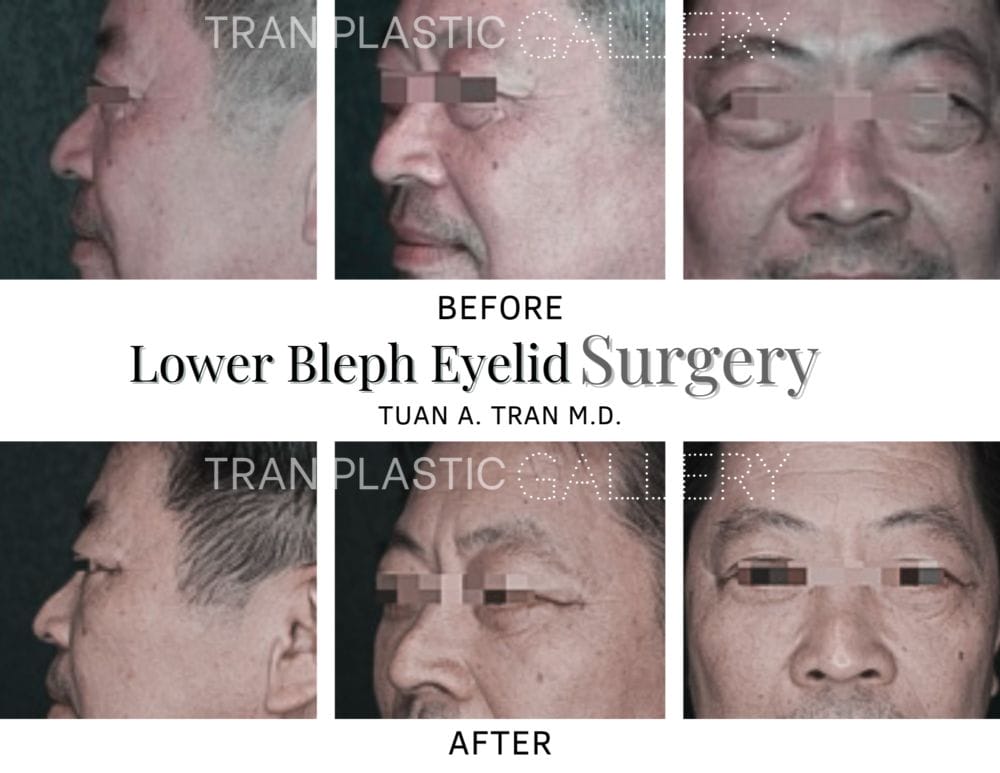 Tran Plastic Surgery - Lower Bleph Eyelid Surgery