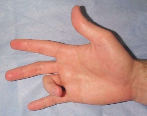 Trigger Finger - Tran Plastic Surgery