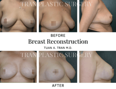 Tran Plastic Surgery - Breast Reconstruction