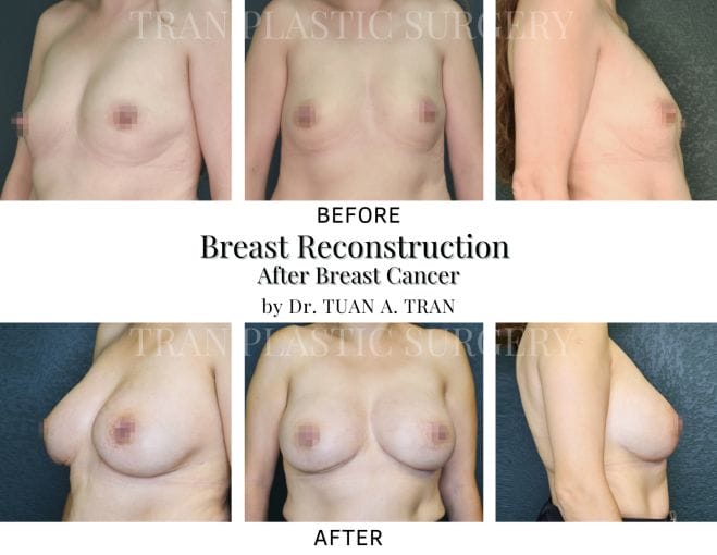 Tran Plastic Surgery - Breast Reconstruction