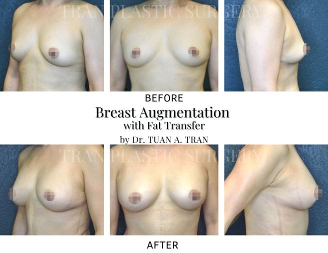 Tran Plastic Surgery - Breast Augmentation with Fat Transfer