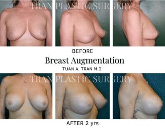 Tran Plastic Surgery - Breast Augmentation