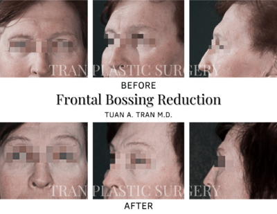 Tran Plastic Surgery - Frontal Bossing Reduction