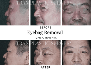 Tran Plastic Surgery - Eye Removal