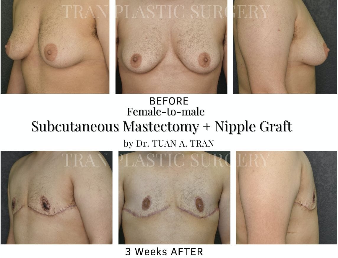Female-to-Male (FTM) Chest Reconstruction