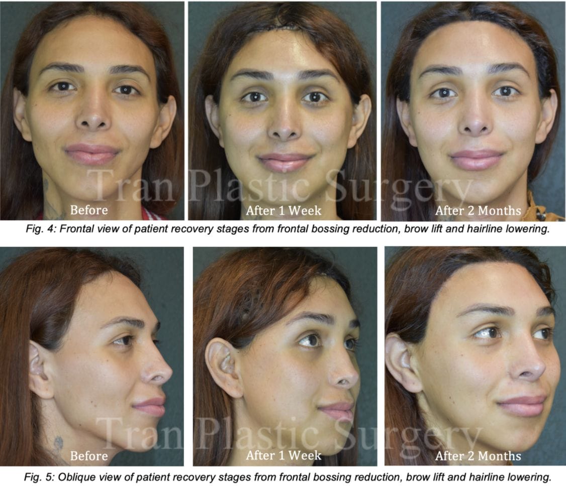 Forehead contouring Before & After