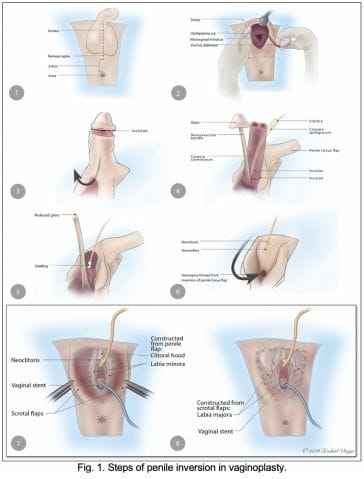 reassignment surgery video