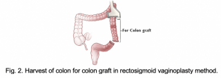 reassignment surgery before and after