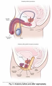 reassignment surgery before and after
