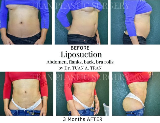 Elimination of back roll following ultrasound-assisted liposuction and