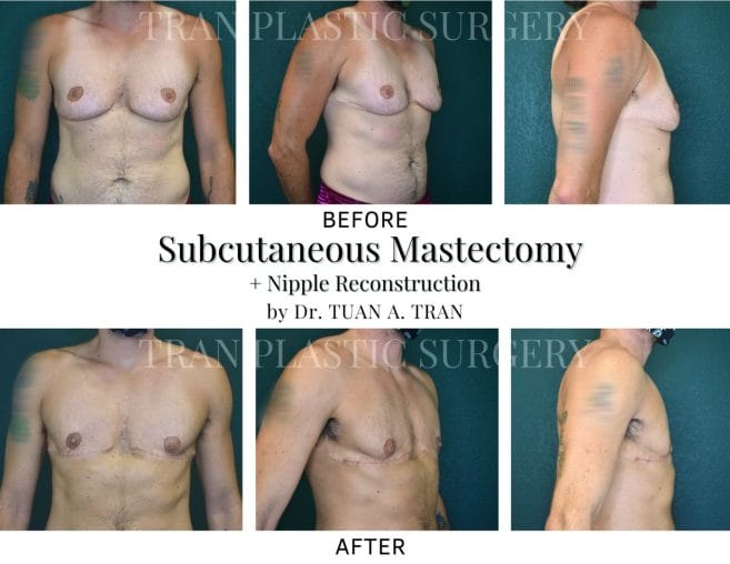 Mastectomy