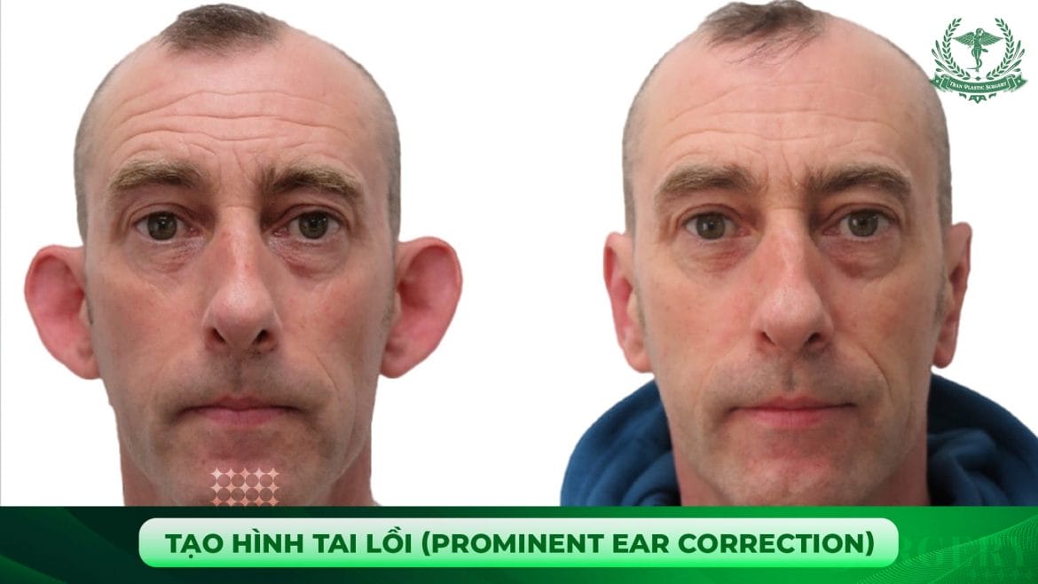 Tạo hình tai lồi (Prominent Ear Correction)